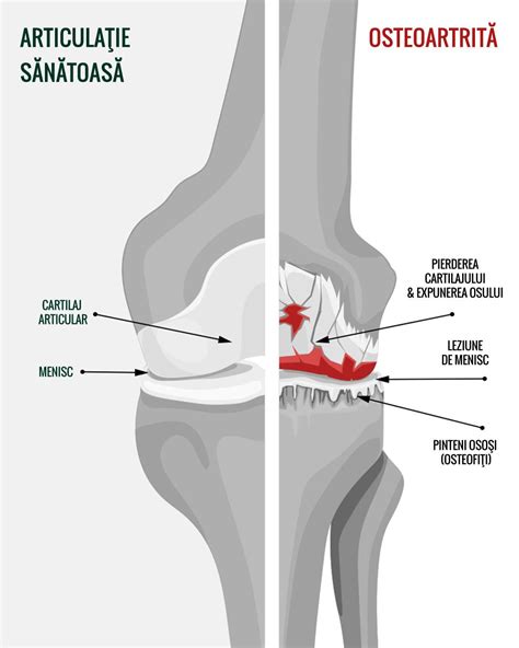 Tratamentul osteoporozei coloanei toracice articulațiile picioarelor comprimate